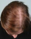 Before Hair Transplant&nbsp;Hair Thinning